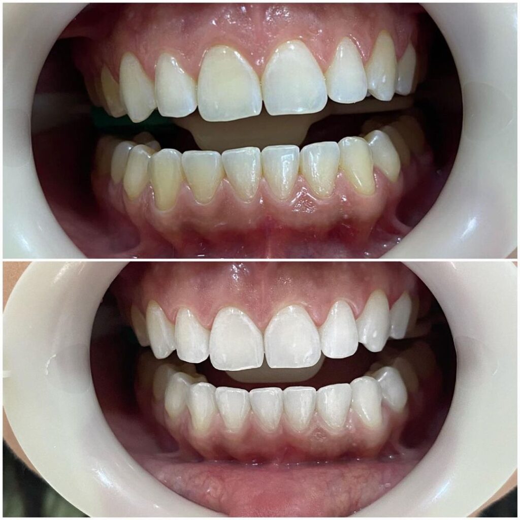 ANTES E DEPOIS 3