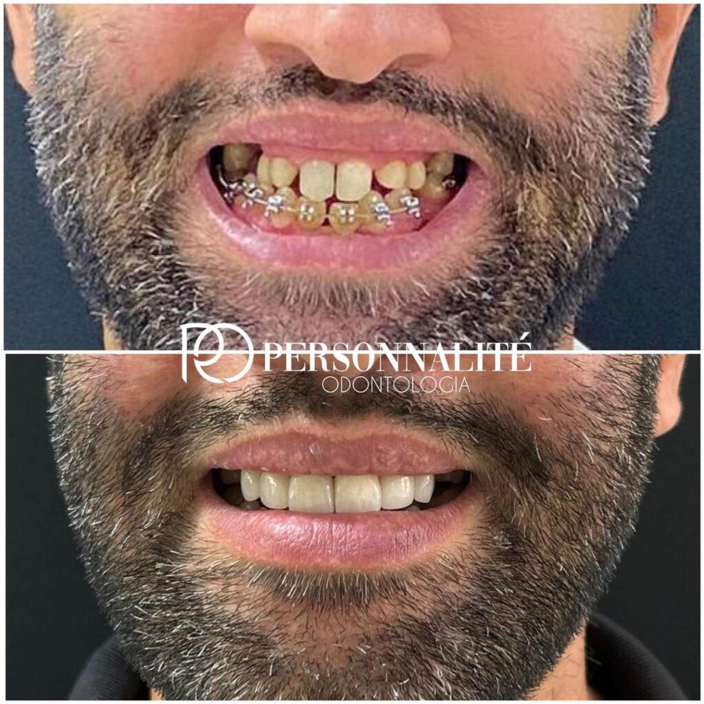 ANTES E DEPOIS APARELHO