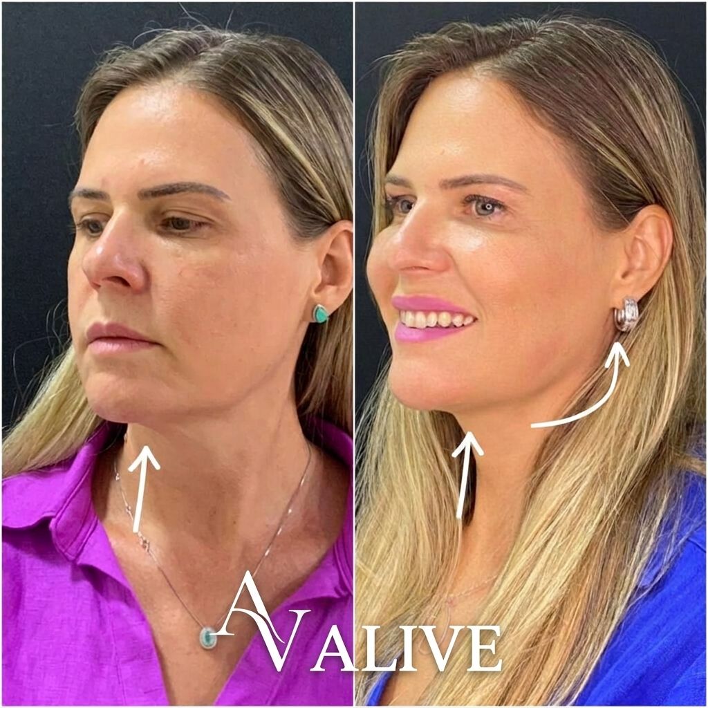 resultado ultraformer alive lateral