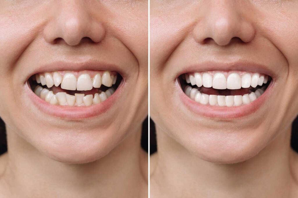 resultados invisalign