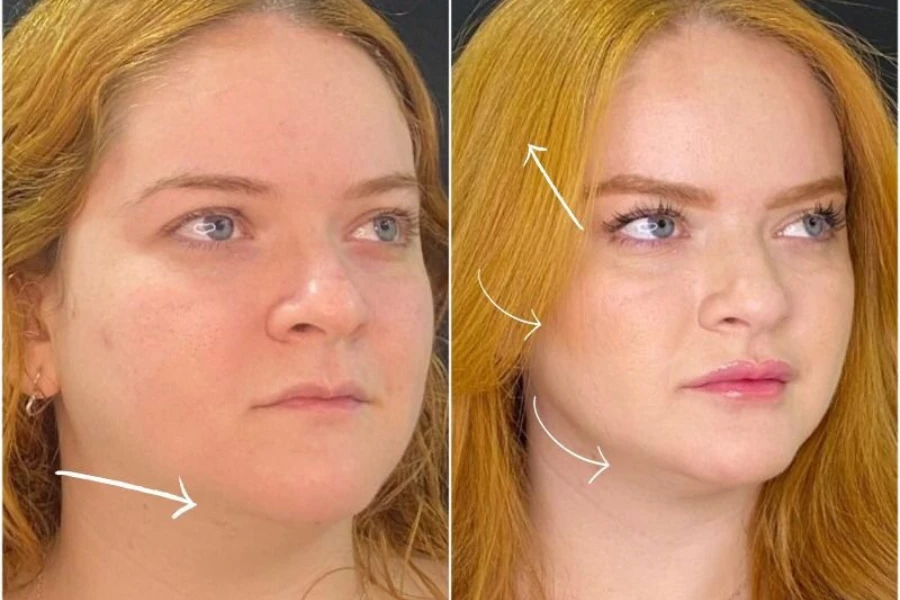 harmonizacao orofacial alive odontologia
